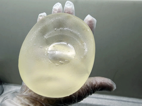 defective-breast-implant